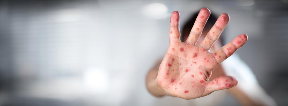 โรคอีสุกอีใส (Chickenpox, Varicella)